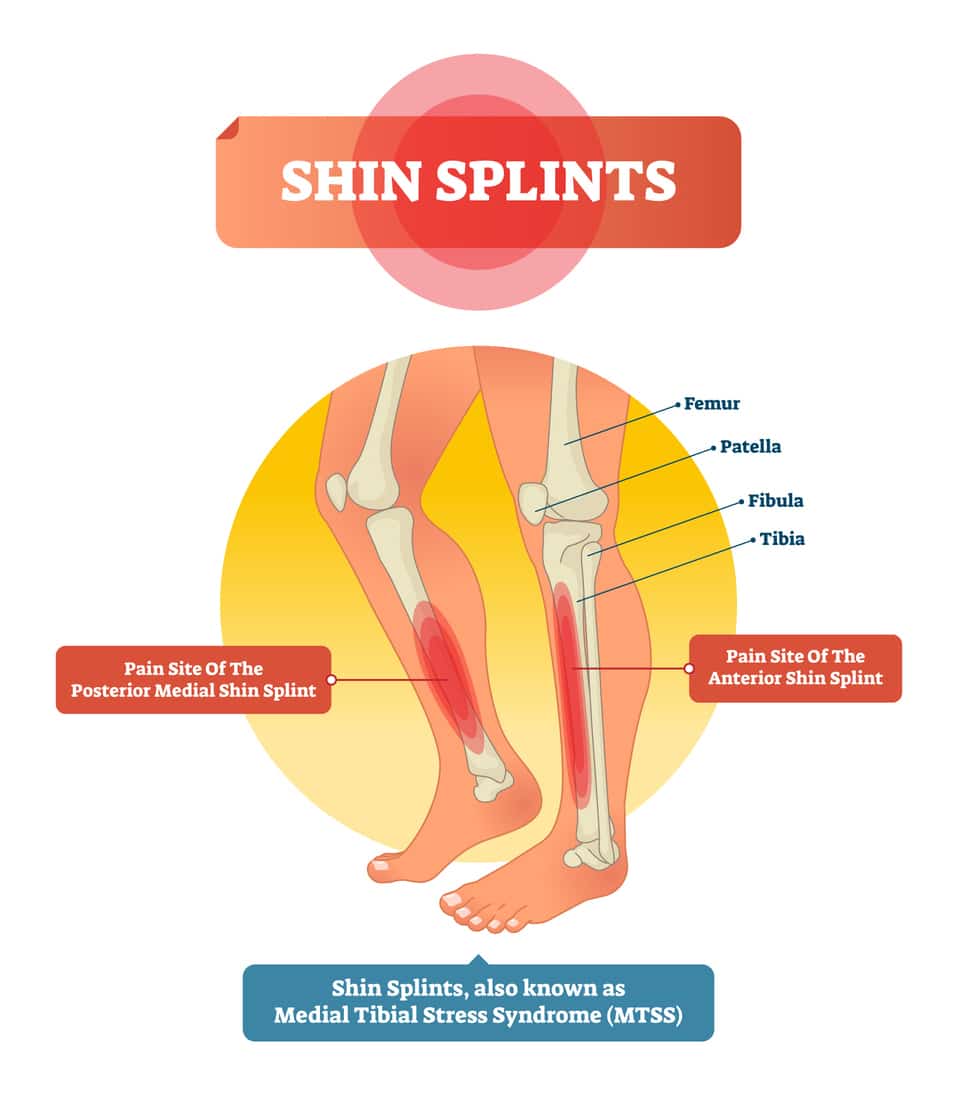 Shin splints pic